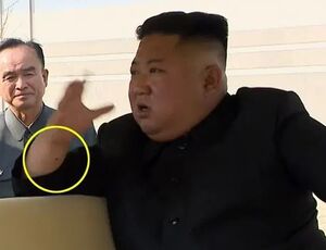 جای سوزن روی دست رهبر کره شمالی